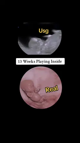 13 Weeks baby playing inside Womb real vs usg #pregnancyjourney #pregnanttiktok #viraltiktok #viralvideo #pregnantbelly #pregnant🤰 #13weekspregnant #13weeks #13weeksold #viralvideo #viraltiktok 