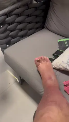 Ajudei meu amigo numa cirurgia fácil a resolver o problema de uma unha encravada