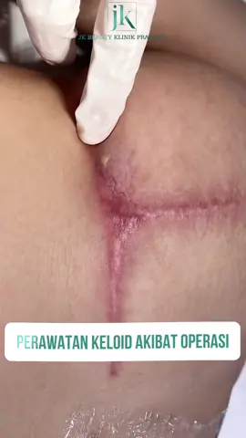 💉Bekas Luka Keloid Pasca Operasi – Bisa Diperbaiki! Pernah berpikir bahwa keloid setelah operasi tidak bisa dihilangkan? 🌿 Faktanya, dengan metode perawatan yang tepat, bekas luka bisa berkurang secara signifikan! JK Beauty Center menggunakan teknologi canggih ScarMax untuk meratakan dan mengecilkan ukuran keloid dengan cepat. Jangan biarkan bekas luka mengingatkan Anda pada masa lalu yang tidak diinginkan – Inbox sekarang untuk konsultasi perawatan yang sesuai! #jkbeauty #korean #keloidtreatment #keloidscar #keloidjakarta #beauty