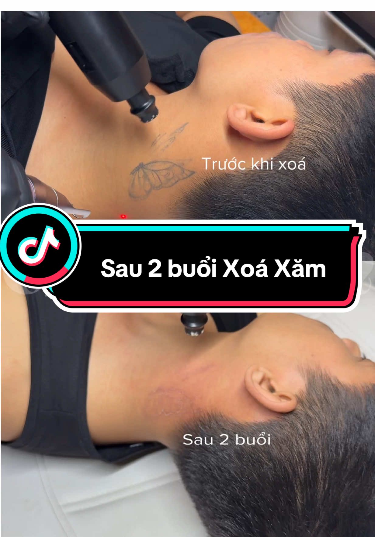 Sau 2 buổi xoá hình xăm teoong sẽ như thế nào ? #xoaxamuytin #xoaxamlaserpico #xoaxamhanoiuytin #xoá_xăm #Gianganhxoaxam #xoaxamkhongseo #xuhuong #reviewxoaxam #ketquaxoahinhxam #diachixoaxamuytin #hanoixoaxam #diachixoaxamtaihanoi #xoaxamlaser #hinhxammini #viral 