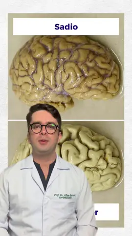 Você já viu como fica o cérebro de um paciente com Alzheimer? Então se liga nesse vídeo que eu vou te explicar. #assuntosaúde #professorallanbatista #alzheimer 