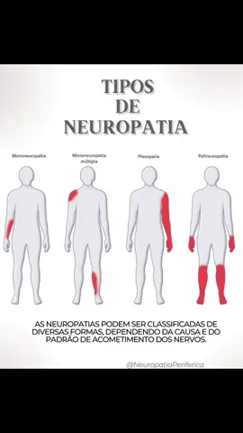 TIPOS DE NEUROPATIA  A neuropatia periférica é uma doença que afeta os nervos periféricos do corpo e causa reflexos em áreas como mãos, pés, pernas e braços. Isso pode resultar em perda de sensibilidade e atrofia muscular nessas partes. É uma doença que pode surgir em qualquer faixa etária, é mais comum em pessoas acima dos 40 anos. Quando descobri a neuropatia periférica eu tinha 25 anos. . . . #espondiloartrite #entesites #dorcrônica #doençaautoimune #espondiliteanquilosante #fibromialgias ##reelsviral #neuropatia #nervos #periferico @Mi Combate à Espondiloartrite 