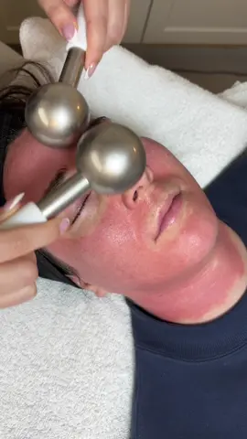 Her sun spots & pigmentation have lightened tremendously with Microneedling (even her fine lines and pore size has decreased). She stayed consistent with her monthly sessions and after her third appointment we saw amazing results!  #microneedling #microneedlingvancouver #microneedlingrichmond #antiaging #sunspots #pigmentation #facialsvancouver #antiagingskincare #antiagingvancouver 
