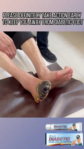 💙 Take care of your diabetic feet with daily nourishment! Biancat™ VitaGluco Diabetes Treatment Cream boosts healing, improves circulation, and deeply hydrates dry skin—keeping your feet healthy every day! ✨🦶✅-634424