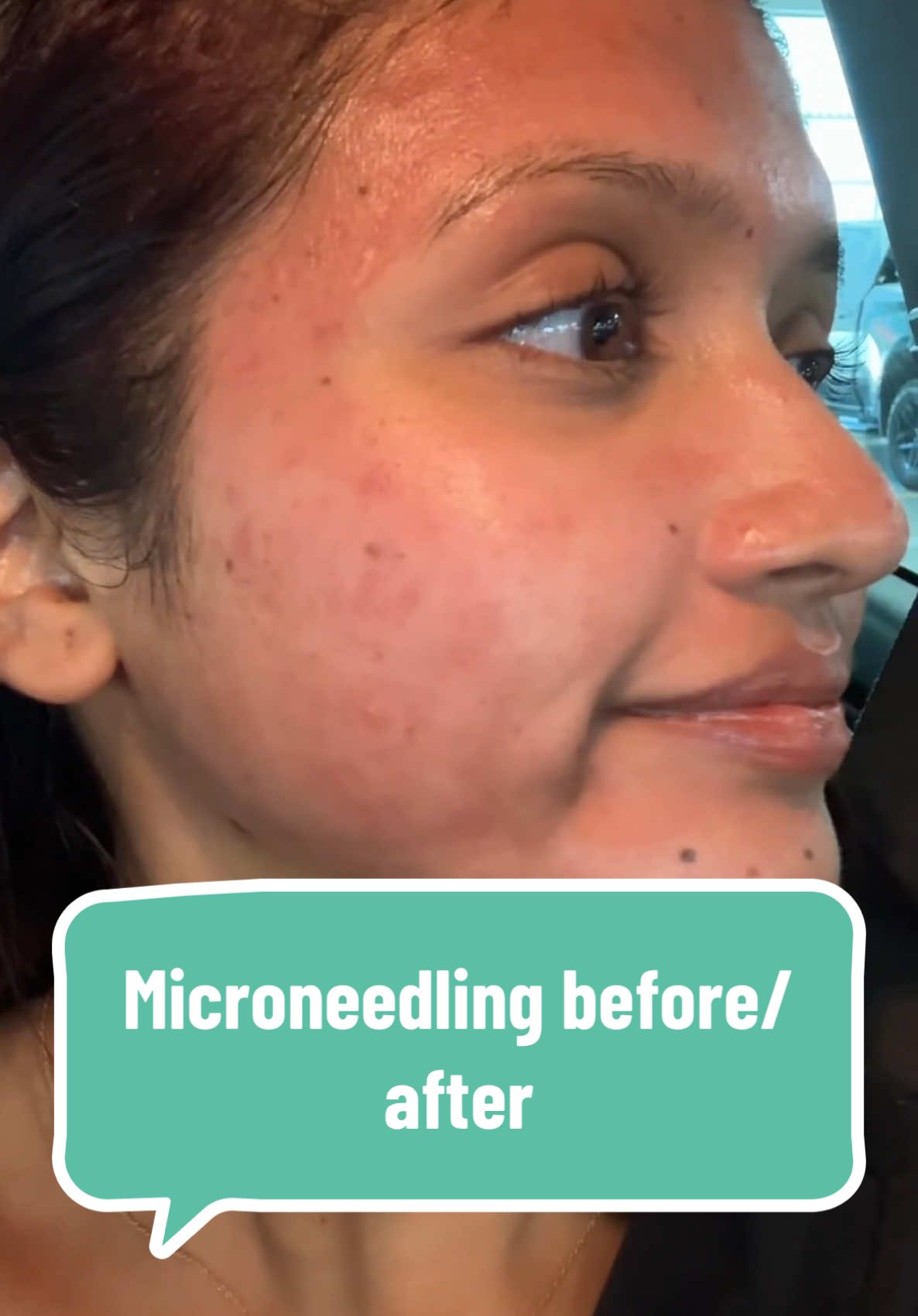 Finished 3 microneedling sessions for acne scars. Worth it… or not really? Do you see a difference? #microneedling #acnescars #microneedlingbeforeandafter 