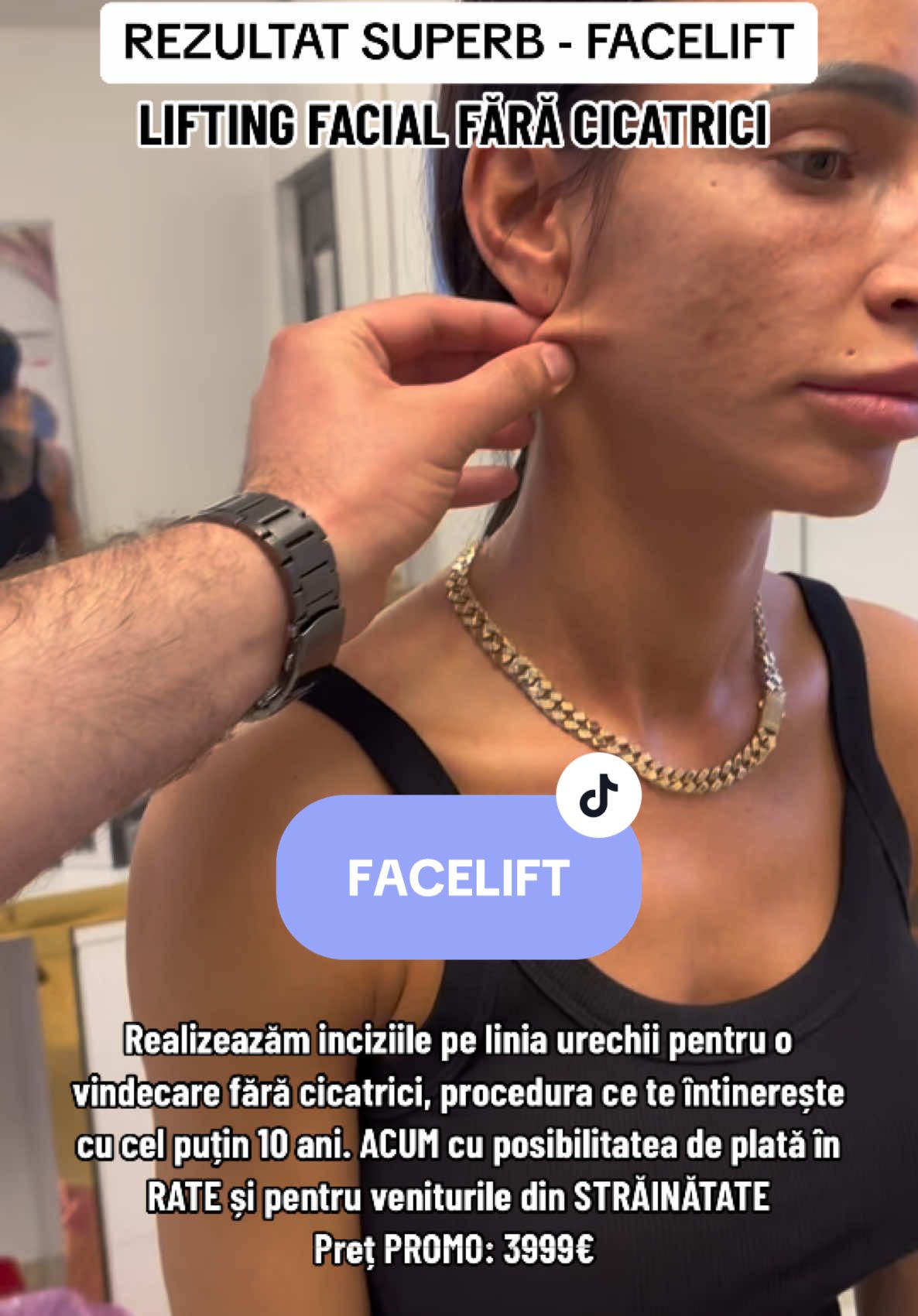 Un rezultat superb de lifting facial #legacymed #surgery #doctor #browlift #facelift #liftingfacial #endobrowlift #browlifting #temporallift #necklift #antiaging #ponytail #aestheticclinic 