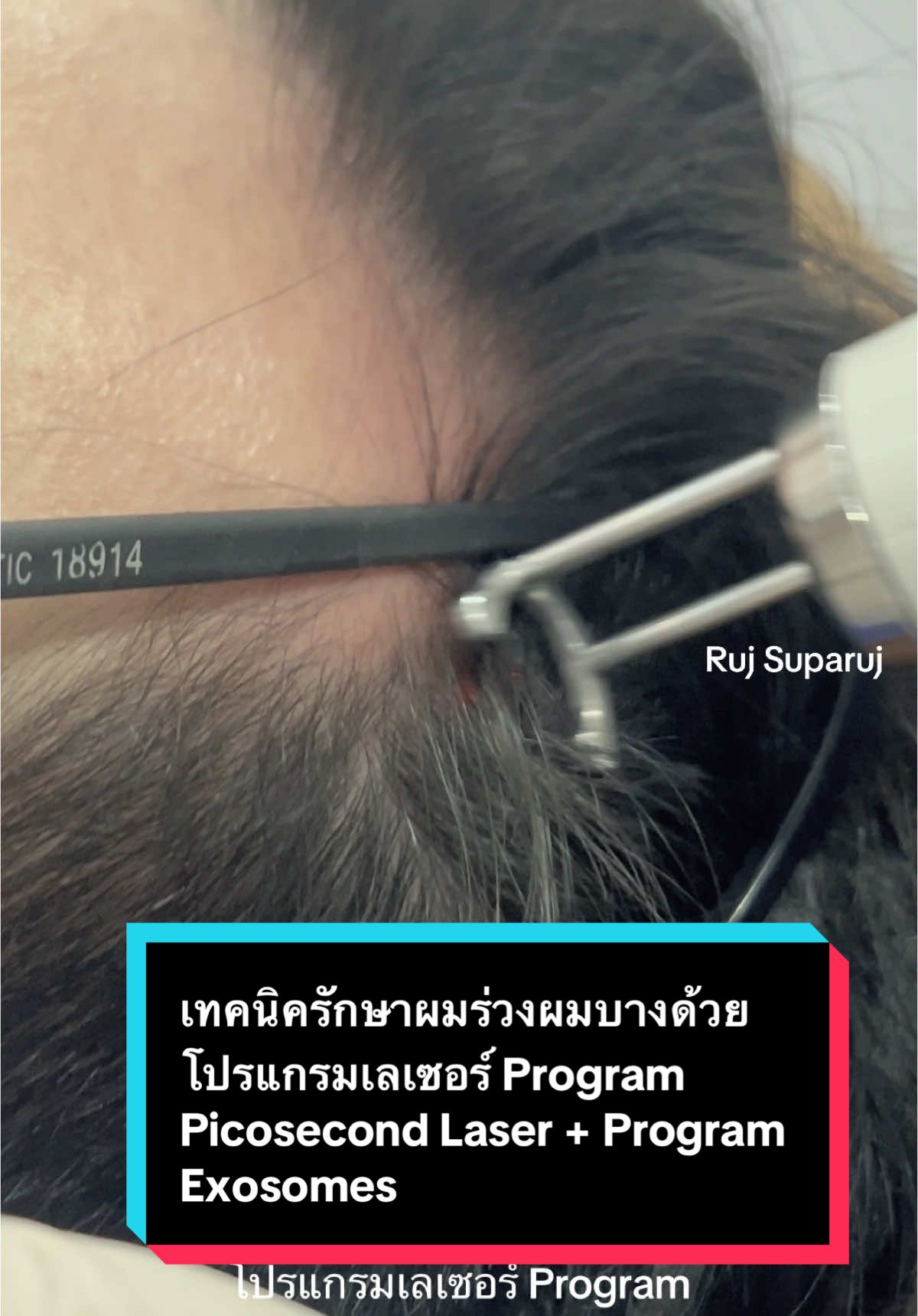 เทคนิครักษาผมร่วงผมบางด้วยโปรแกรมเลเซอร์ Program Picosecond Laser + Program Exosomes เทคนิครักษาผมร่วงผมบางด้วยเลเซอร์พิโคแบบแบ่งส่วน Fractional Pico Laser for Hair Loss Treatment   ลักษณะพลังงานของการใช้เลเซอร์พิโคแบบแบ่งส่วนทำให้เกิด LIOB Laser induced optical breakdown ช่วยการกระตุ้นการงอกใหม่ของเส้นผมได้ครับ 🔬Fractional Pico Laser for Hair Loss Treatment** The energy characteristics of using fractional pico laser cause Laser Induced Optical Breakdown (LIOB), which helps stimulate hair regrowth. Reference อ้างอิง J Clin Aesthet Dermatol. 2024 Jan;17(1):24-27. #รักษาผมร่วง #รักษาผมบาง #ผมร่วง #ผมบาง โปรแกรม #picosecondlaser #picolaser #เลเซอร์ผมร่วง #rujsuparuj #รุจชวนคุย #demedclinic #เรื่องผิว #รีวิวบิวตี้ โปรแกรม #exosome @Ruj Suparuj 