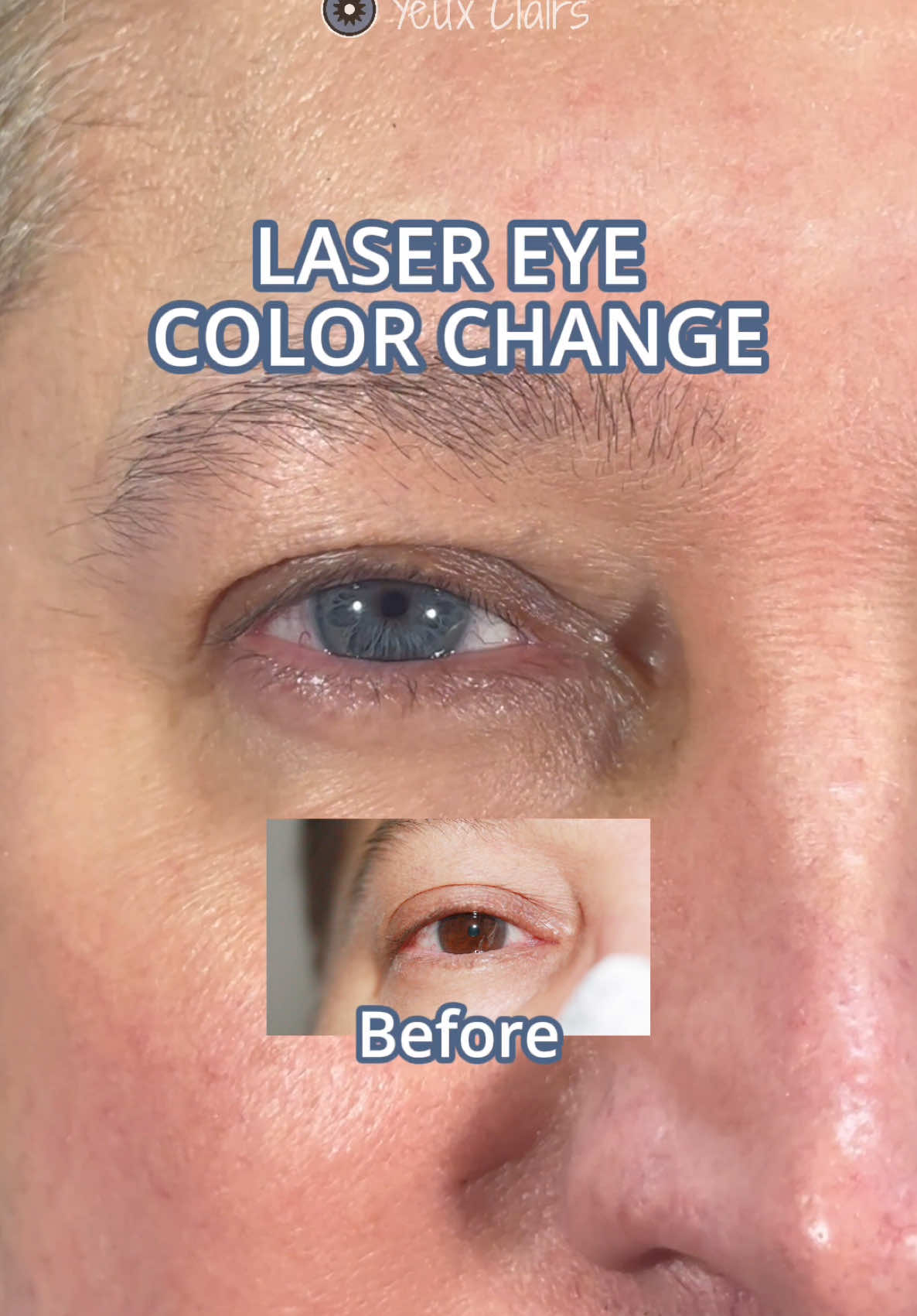 Eyes that match an unstoppable energy. 💪 More results: www.yeuxclairs.com #yeuxclairs #realtreatmentresult #beforeandafter #eyecolorchange #eyecolorchangesurgery #eyecolorchanges #safeeyecolorchange #permanenteyecolorchange #lasereyercolorchange 