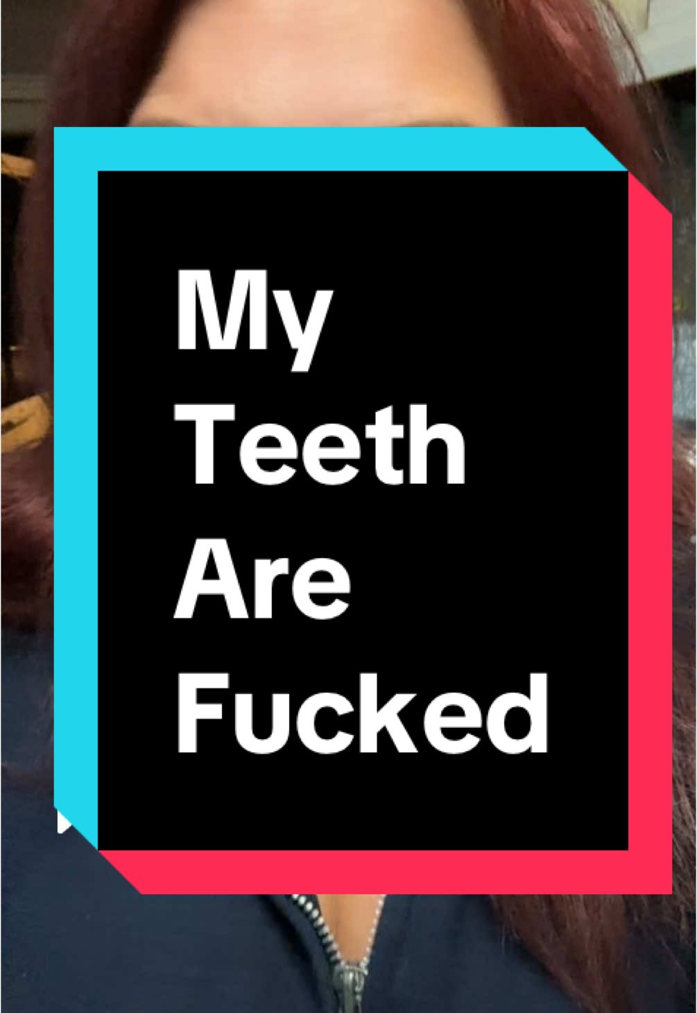 Replying to @? for those who will ask again, I was born with a birth defect, where there was no roots for adult teeth underneath certain baby teeth in my mouth therefore, those baby teeth carry through into my adult life. I do have some screws that were replaced when I started the dental work years and years ago to get the baby teeth removed and implants placed however I very quickly ran out of money to complete the work so the remaining baby teeth are now just crumbling. My son also has the same birth defect. Only he’s missing for less teeth than I was r#findingfamilyinchaos #dental #teeth #dentist #dentalwork #brokenteeth 