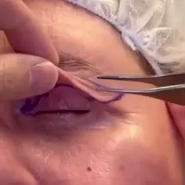 🥳No need for invasive procedures or injections! ✅Reducing wrinkles / ✅Combating facial sagging / ✅Lifting sagging eyelids / ✅Smoother, firmer skin / ✅Deeply hydrating ✨ Fight back with our advanced wrinkle removal cream – the solution for smoother, firmer skin. This powerful formula smooths out wrinkles, lifts sagging eyelids, and deeply hydrates, giving you a youthful, refreshed appearance. Say goodbye to aging signs.