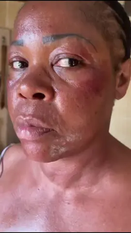 Guys we don’t joke about your Skin. We have gotten the formula for redness removal. And that’s what has been helping our customers clear their FACE REDNESS  Meet Mummy. She came to us with doubt because she have spent a lot of money yet with no results. But after using EST REDNESS PRODUCTS. That changed. Look at the way her Youthfulness is back  Yes we cleared her FACE REDNESS and her CONFIDENCE IS BACK When we recommend for your skin repair stick with the product and watch your skin transform for good. Click on link on bio to take you to Whatsapp to take care of your skin today How to clear my face redness How to clear my red cheeks How to clear my face redness totally What cause face redness Skincare Product that clear face redness Redness on my face Clear my face redness How to clear my damaged skin How to repair my skin barrier How to repair my bleached Skin Skincare brand that clear Redness in Nigeria Best skincare plug in Ibadan #estdermiscare #estdermis #estdermiscare #estdermiscarerednessoil #redness #rednesscorrector #rednessrelief #rednesscare #rednessreduction #rednessoncheeks #skincaretiktok #skincaretips #skincarejourney #bleachingcream #skinbleaching #skincareadvice #estdermiscare #estdermis #redness #estdermiscarerednessoil #rednesscorrector #rednessrelief #rednessprone #skinrepair #viral_video #fypp #skinbleaching #skinhealth #holisticbeauty #youthfulskincheck 