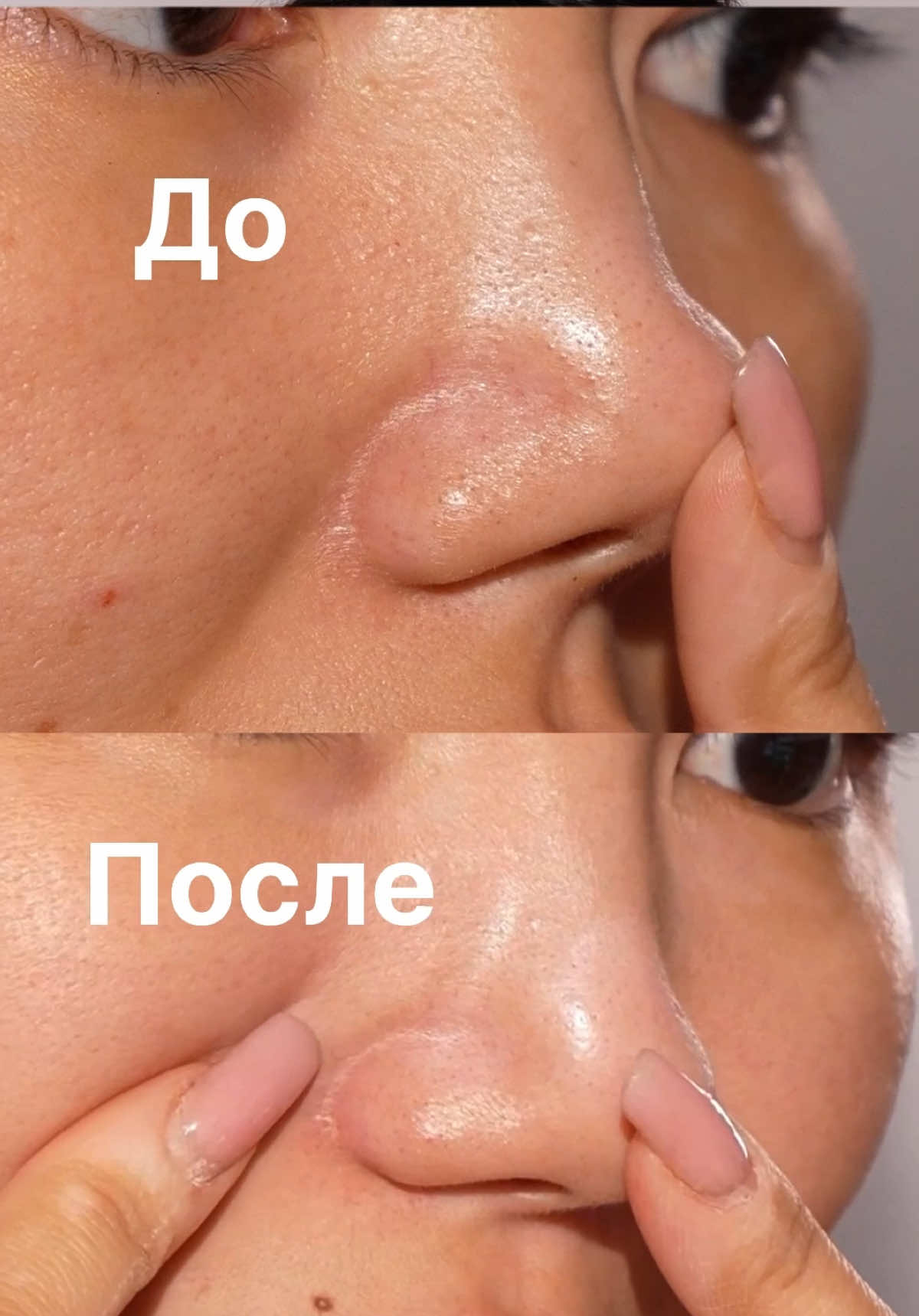 Легко избавляемся отчерных точек за монуту и без боли!