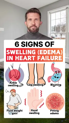 6 signs of swelling in heart failure #healthy #healthcare #healthtips #heart #heartfailure #heartdisease #swelling #edema 