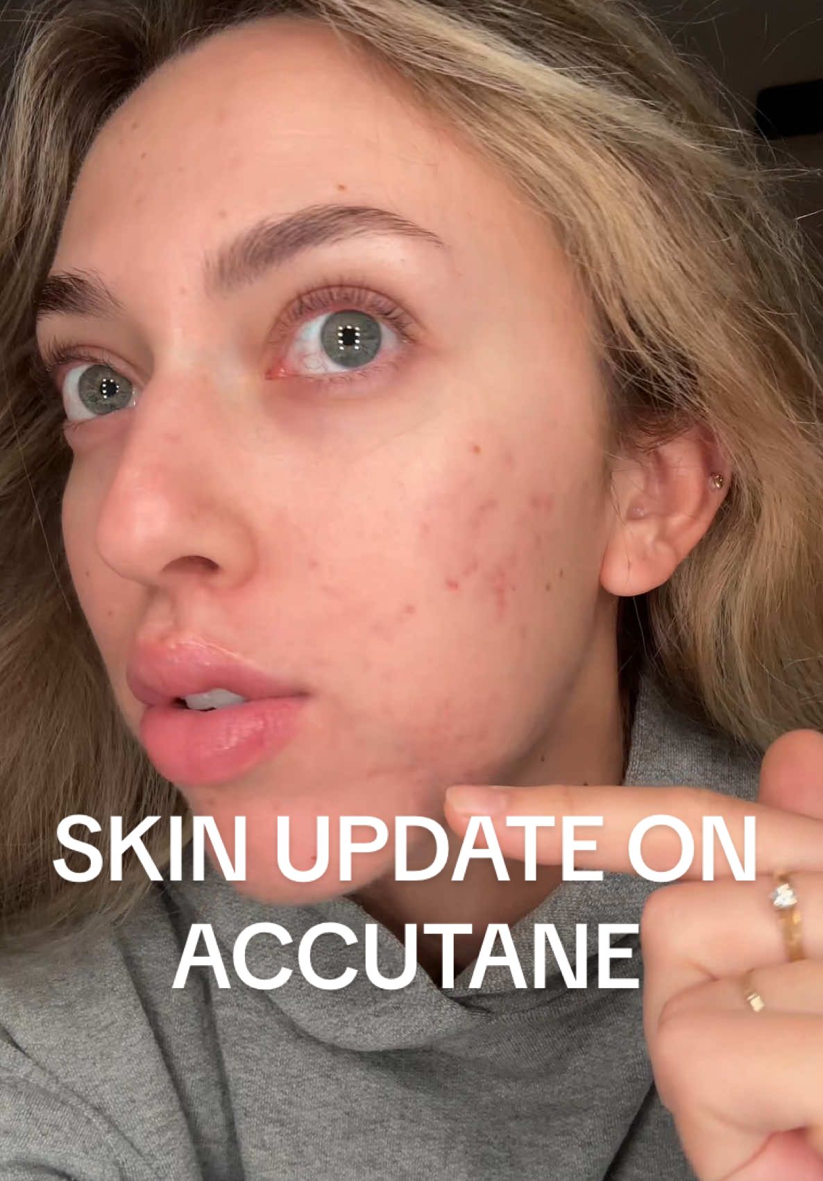 I can finally relate to that one song “I woke up like thissssss” 🥹🥹🥹🥹 sending extra love and a big hug to those struggling on their journey today🤕🩷 #accutane #accutanejourney #accutanecheck #accutanepurge #acne #acneskin #acnescar #acnescars #acnefighter #acnejourney #acneproneskin 
