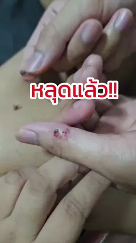 หูดหลุด! มาเป็นหัว! รีวิวจริง จากผู้ใช้งานจริง หลุดจริง! #แผ่นแปะหูด #แผ่นแปะหูดตาปลา #ตาปลา #แผ่นแปะตาปลา #ตาปลาที่นิ้วมือ #หูด 