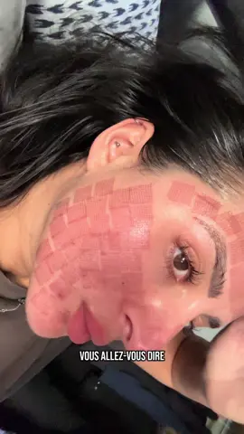 PEELING LASER CO2 (demander l’avis d’un professionnel de santé avant chacune de vos prestations ❤️) @LalkaParis 🤍 #peeling #peelingskin #laserco2 #co2laser #co2fractional_laser #co2laserskinresurfacing 