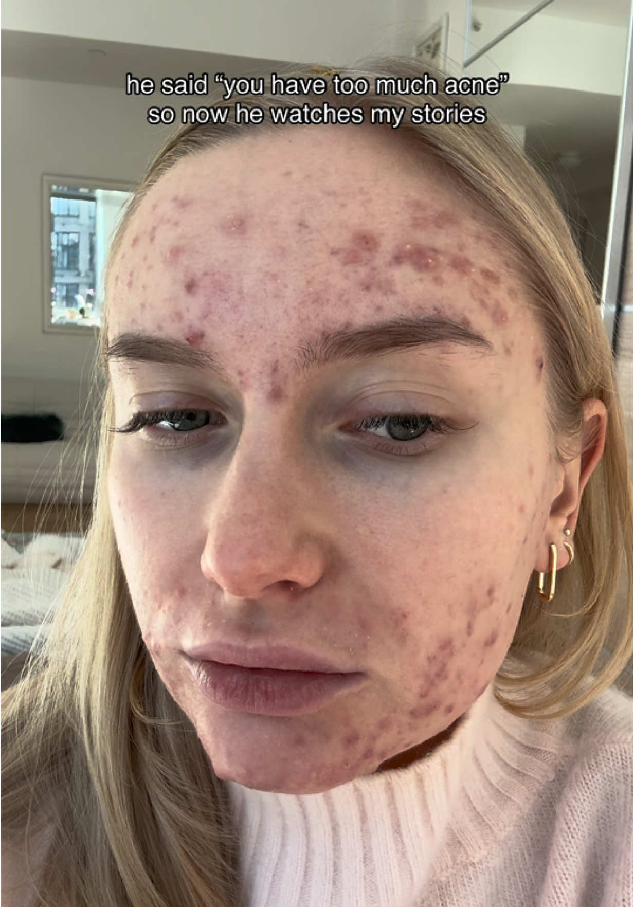 And that’s where he belongs #acne #newyork #nyc #newyorkcity #nyccontentcreator #contentcreator #goals #nycinfluencer #insecurity #motivation #acnejourney #confidence  #accutane #acnescars #acnescarring #girls #relatable #relateable #skin #skincare  #skinjourney #selfworth #SelfCare #selflove #loveyourself