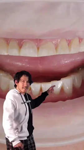 Obsessed with this smile transformation! Can’t stop watching this try-on veneer moment—absolute perfection! ✨😁  ✨ Transform your smile in just 2–3 visits! ✨ 📍 Dr. Tejas Patel | Austin, TX | Treating patients nationwide ✈️ 💳 Flexible financing available with CareCredit & Cherry 📲 Book your free consultation today—link in bio! Got questions? Send us a DM! Let’s create your dream smile. 😁 #porcelainveneers #minimalprepveneers #atxveneers #veneers #dentist #sanantonio #sanmarcos #texasdentist #kyletx