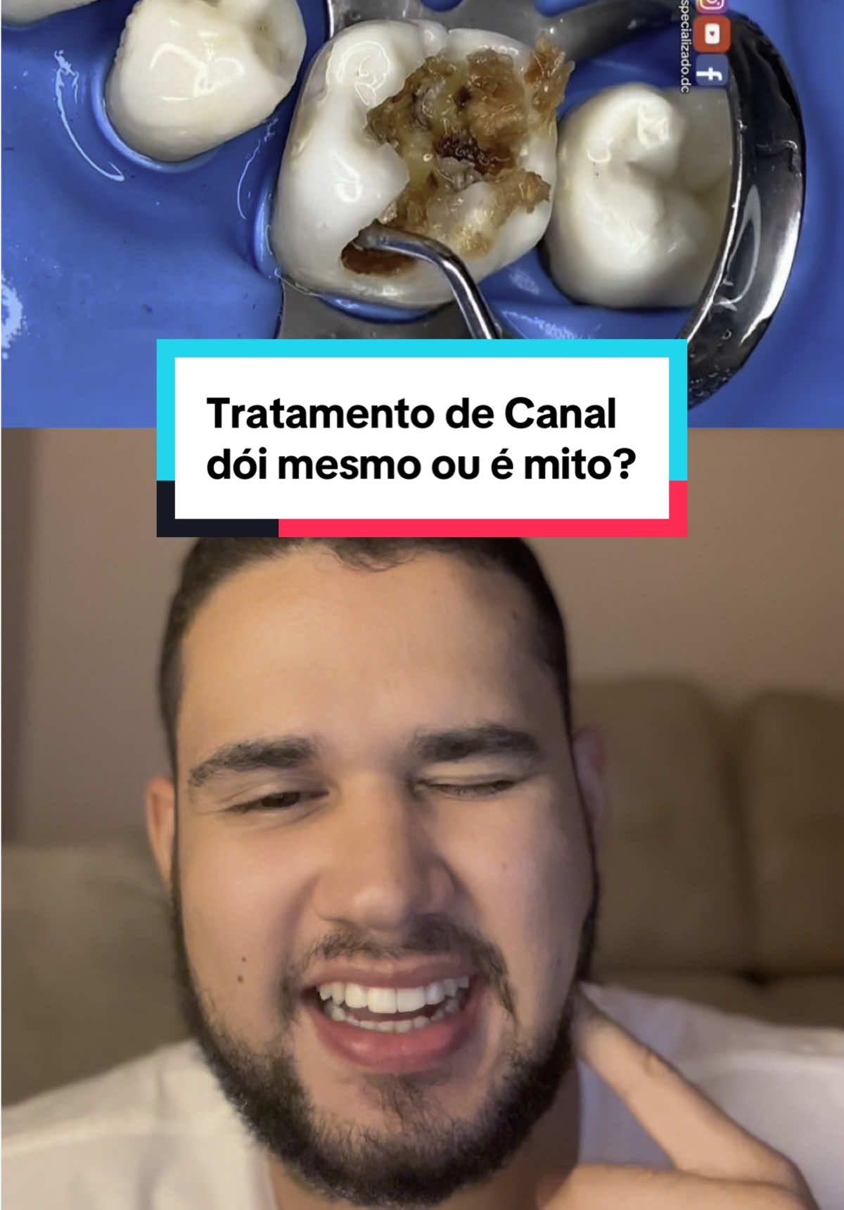 Esse é o Tratamento de Canal #odontologia #dente #dentista 