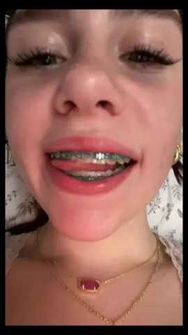 GOOBYE BRACES 😬 #bracesoff #newsmile #fyp #dontletthisflop #sabrinacarpenter 