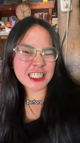 Moldable False Teeth #moldablefalseteeth 