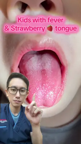 Strawberry 🍓 tongue is a physical sign seen in patients with Kawasaki disease, Scarlet fever and Toxic Shock Syndrome.  #KawasakiDisease #StrawberryTongue #ChildrenHealth #Fever