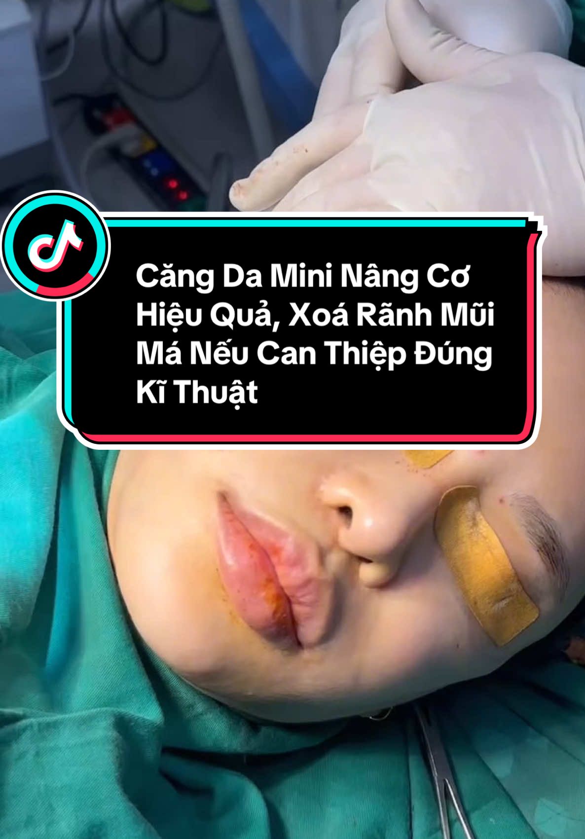 Tại Sao Căng Da Mini Bên Bs Long Lại Hiệu Quả Nâng Cơ Hơn Các Bên Khác #xuhuong #trending #drlongck1pttm  #cangdamini #căng_da_mặt #cangdamat #smasfacelift 