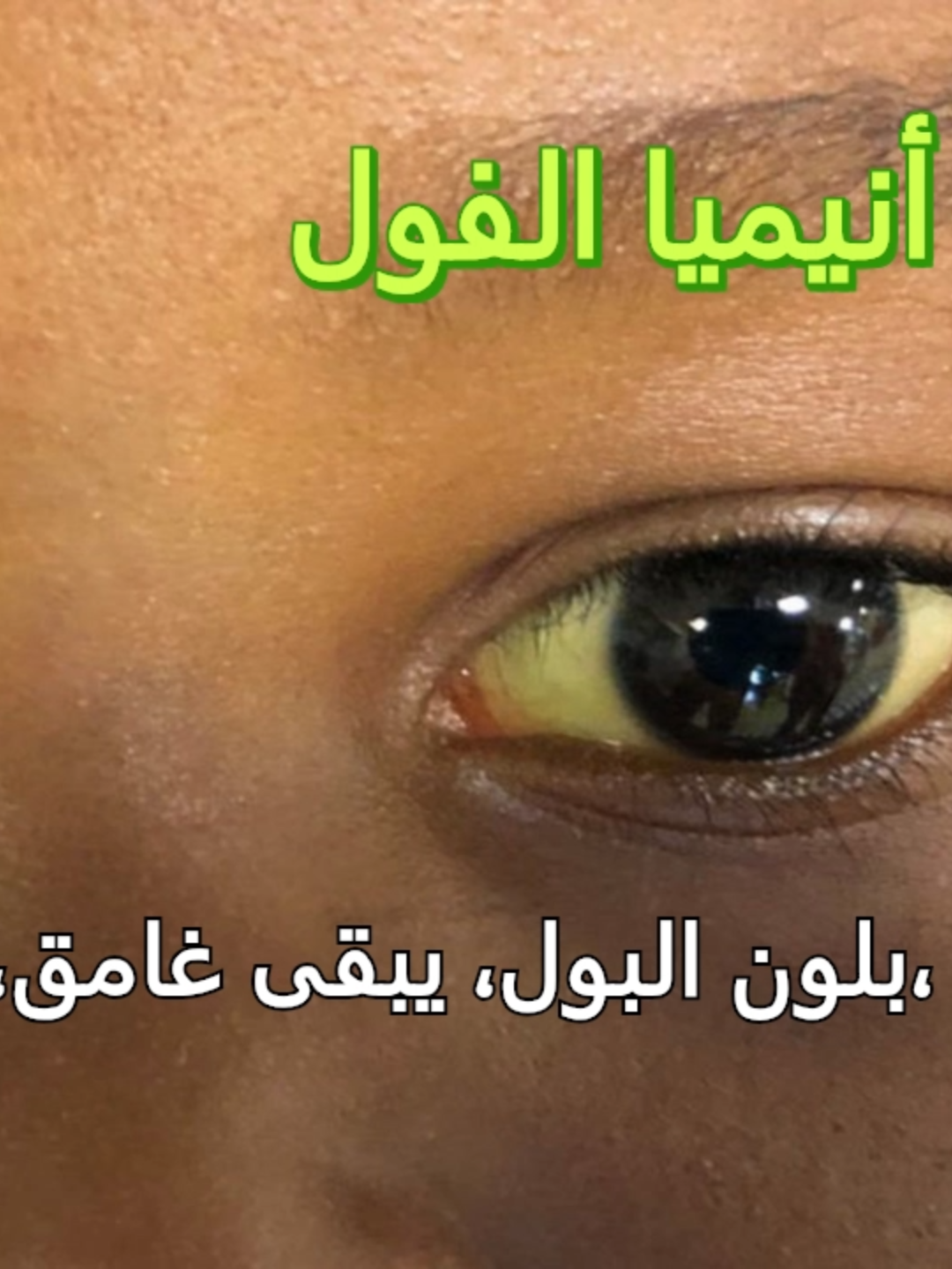 أنيميا الفول ماهي الأسباب والأعراض؟  #foryou #foryoupage #fyp #د_فتوح_حسانين #اطفال_التيك_توك #الأمهات #اكسبلور #انيميا_الفول #انيميا