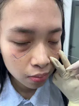 Sự khác biệt sau khi tiêm 1 bên trị thâm làm đầy trũng mắt #tiêmmôi #môiTây #xuhuongtiktok #botox ##fillerbotox 