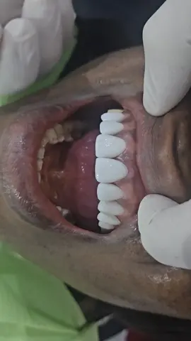veneer trial stage#veneers #crowns #smiledesign #nigeriantiktok #goviral #abuja #viralvideotiktok #FYI ##medicaltourism #emaxveneers #confidence 
