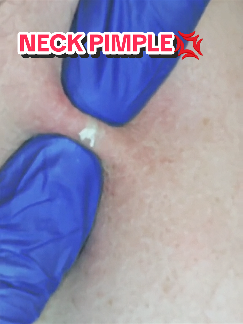 Does this neck is real?#creatorsearchinsights #pimples #pimples #pimplepopper 