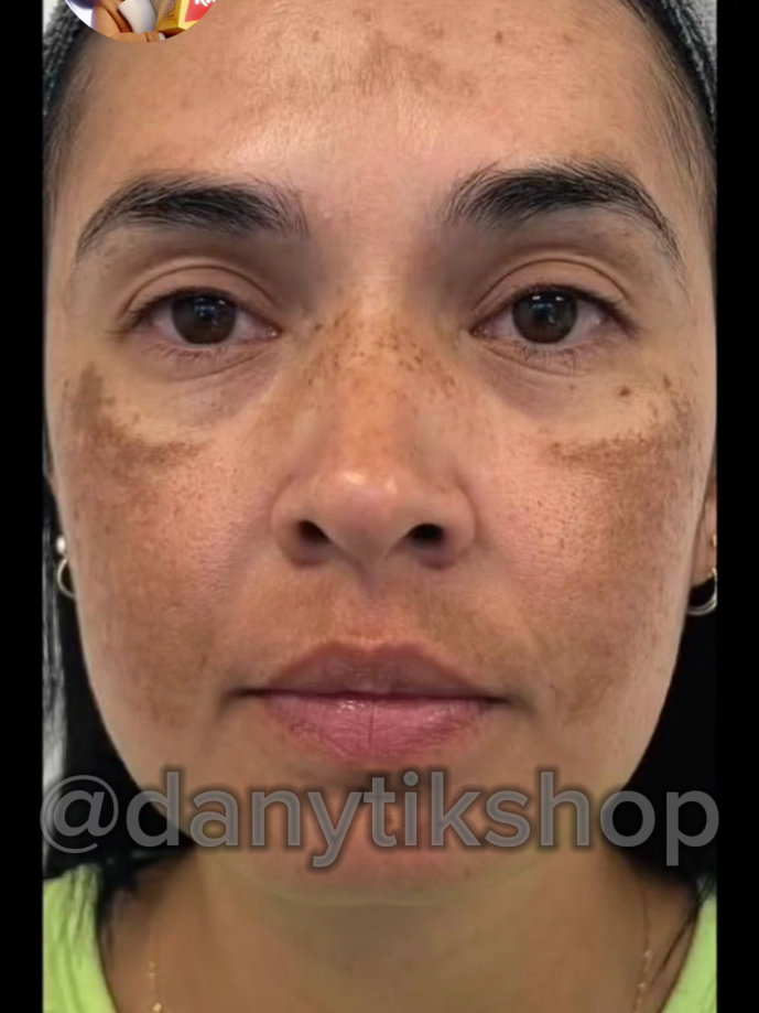 Kit de tira manchas do corpo #manchas #micosan #corpo #rosto 