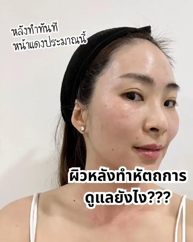 ✨ใครผิวบางหลังทำเลเซอร์หรือหัตถการ แล้วหน้าแดงๆ ผิวเปิด ไม่รู้จะดูแลผิวยังไงวันนี้มีทริคมาบอกค่ะ ✨กันแดดที่ปกป้องผิวหลังทำเลเซอร์ได้ดีที่สุด ขอยกให้ Eucerin Sun Ultra 100 UV+ เลยค่ะ จะบอกว่าตัวนี้คือที่สุดของการป้องกันแดดแล้วเทอ SPF 112 PA++++ ปกป้องสูงมากกกก คือยิ่งใครแบบผิวบางจากการทำเลเซอร์หรือหัตถการที่แบบ หน้าแดงๆ หรือผิวเปิดนะ ยิ่งจำเป็นสุดดด! ✨คือยิ่งหลังทำเลเซอร์อะ จะเป็นช่วงที่สำคัญที่สุด ผิวจะ Sensitive มากๆ ต้องดูแลให้ดีที่สุด เสี่ยง UV ทำร้ายผิวเรามากกกแบบสุดๆ คือเอาจริงๆ ยิ่งตอนเราผิวบางๆนะ ยิ่งต้องโบกกันแดดเข้าไป แล้วต้องเป็นกันแดดที่ปกป้องถึง ปลอบประโลมผิวได้ด้วย ไม่งั้นจากผิวปังจะเป็นพังแน่นอนเทอ  ✨ตัวนี้เค้าแบบคือ Ultra Protect คือผสมสารปกป้อง UVA 2 เท่า แล้วที่ชอบเลยเพราะเขาช่วยปลอบประโลมผิว ลดการอักเสบให้ผิว แล้วยังช่วยฟื้นฟูผิวจากรังสี UV ด้วย เพราะเขามี Lico A และ GA ด้วย คือปกป้องเลิศ บำรุงผิวปังไปอีก ดีไม่ไหว ✨ปกติกันแดด SPF สูง เนื้อจะต้องเหนอะหนะ แต่ตัวนี้เนื้อดีมากกก ทาแล้วซึมไวสุดๆ ตอนเราทำหัตถการหน้าแดงๆ หรือผิวเซ้นซิทีฟตัวนี้ตอบโจทย์มากๆ คือลองมาแล้วตอนที่หน้าแบบแดงๆ ผื่นๆเลย ได้ตัวนี้มาช่วย บอกเลยเวิร์คมากๆ #​ป้ายยาสกินแคร์ #​EucerinSunUltra100 #​กันแดด   #​ป้ายยาlemon8 #​ดูแลผิวหลังเลเซอร์ #Lemon8 