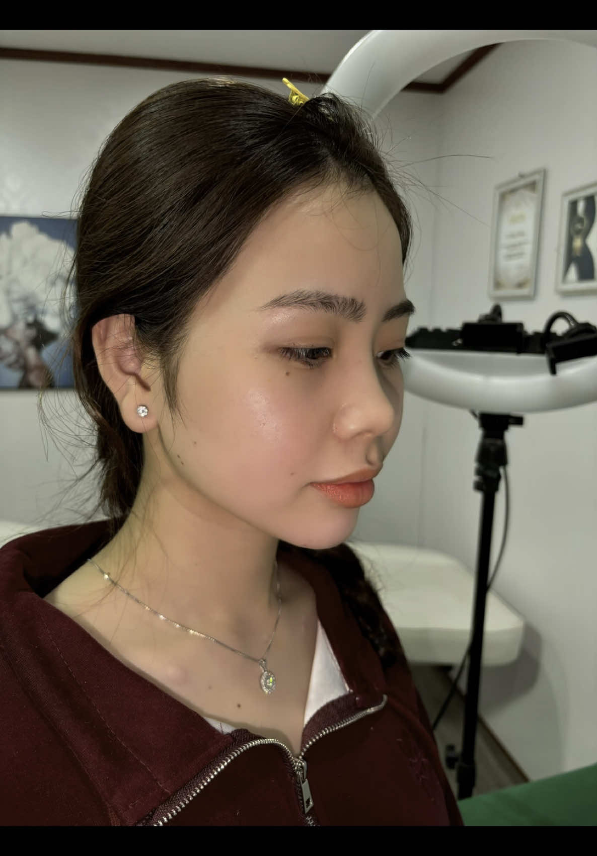 #tiemcam một nốt kim duy nhất không sưng k bầm tím 