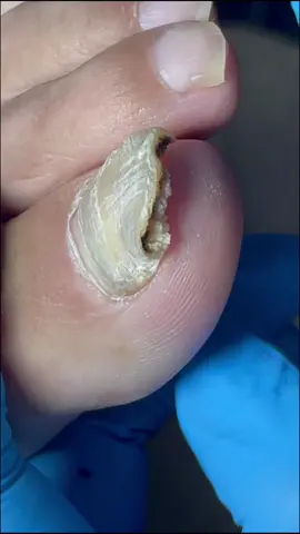 #asmr #satisfying #damagedtoenails #toenailtransformation #pedicure #toenailfunguscure #fungalnails #deepcleaningpedicure #toenails #nails  #ingrowntoenail #asmr #toenailremoval 