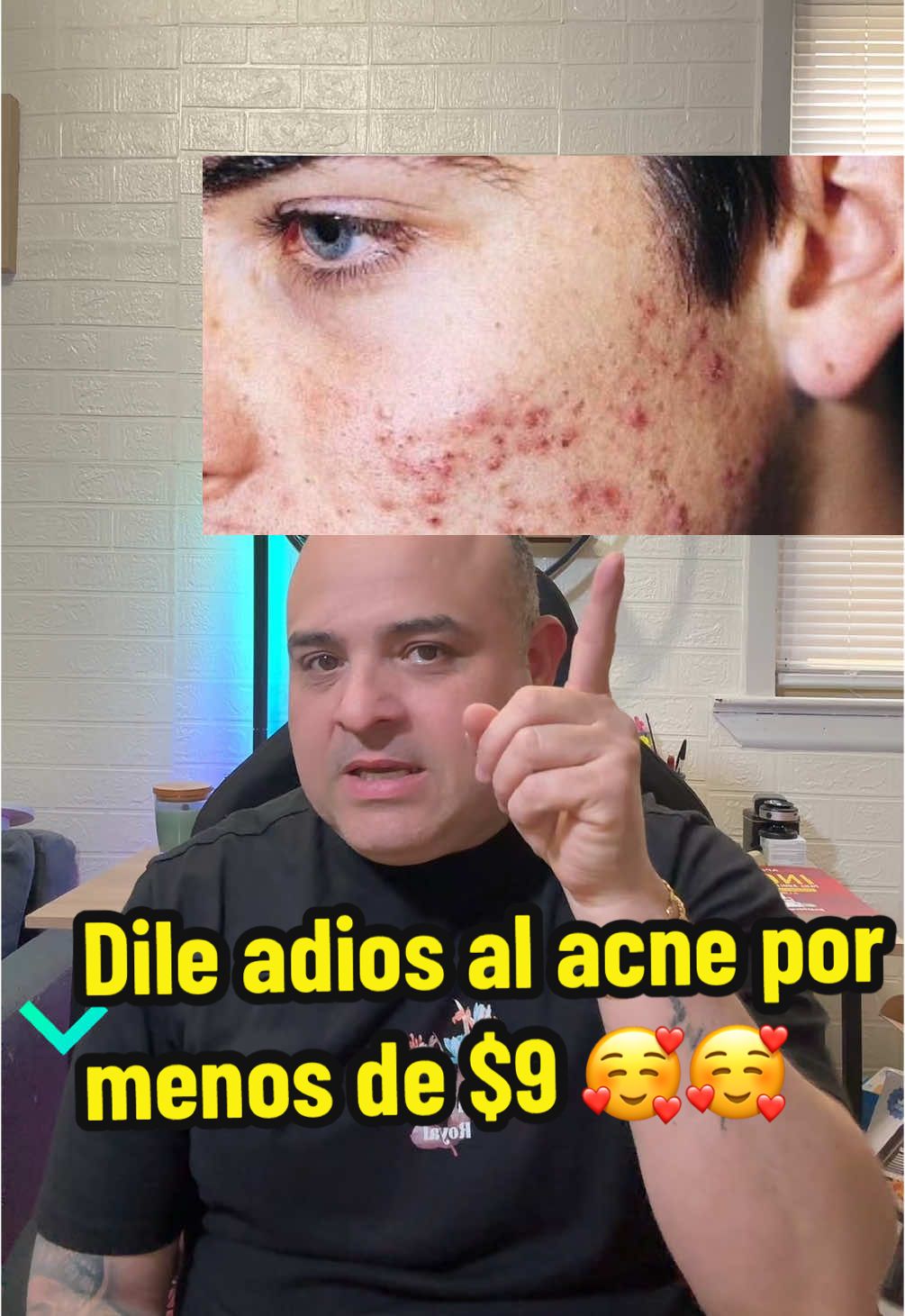 Crema japonesa que te ayudará a eliminar el acné en cuestión de días #acne #antiacne #acneskin #acnetreatment #acneskincare #acneskinroutine #cremajaponesa #skincare #acnetips #skincareroutine #skincaretips #springtok #tiktokshop 