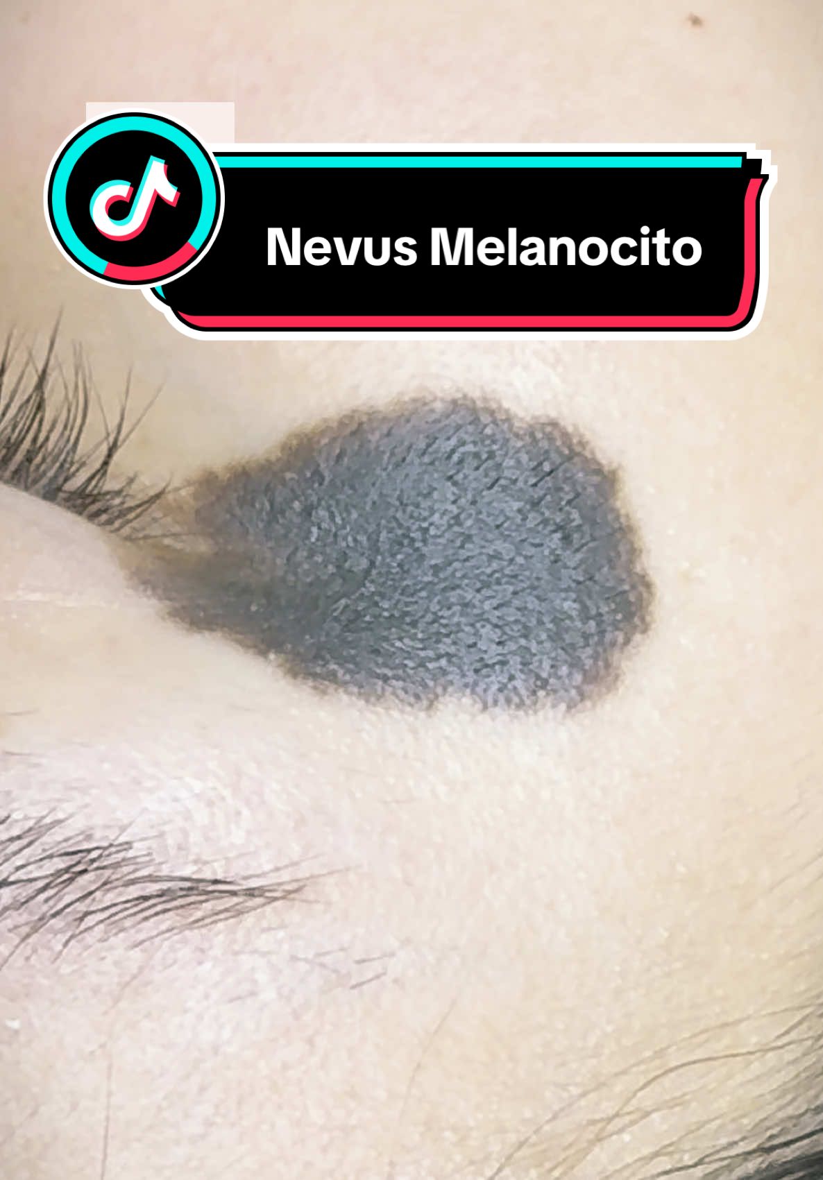 📱❗️❗️Los nevus melanocíticos son lesiones benignas🚨 compuestas por unas células llamadas melanocitos, encargadas de producir pigmento.  Nuestra paciente quedó encantada con su resultado 👩🏻‍⚕️❇️#viral_video #lunar #Miraflores #melissafarfan 
