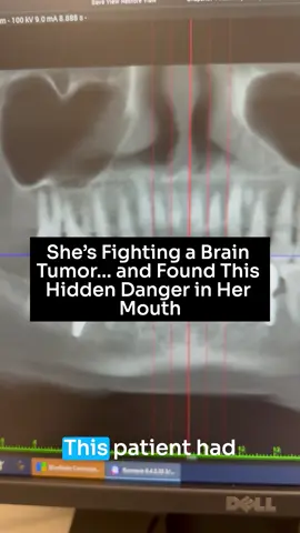 She’s fighting for her life—and she’s starting with her mouth. 🧠🦷 After learning what many cancer survivors had in common, she realized it was time to look deeper. Hidden dental infections and titanium implants might be stressing her body more than she knew. She’s clearing it all out to give her immune system the best chance possible. #holisticdentist #titaniumimplant #dentalimplant #cancer #dentalinfection #toothinfection #teeth