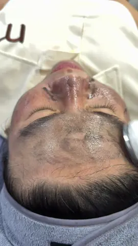 🤩𝑯𝑼́𝑻 𝑪𝑯𝑰̀ - 𝑻𝑯𝑨̉𝑰 Đ𝑶̣̂𝑪 𝑻𝑶̂́ 𝑻𝑹𝑬̂𝑵 𝑫A      ✨ Đã bao lâu rồi chị em chưa thải chì ạ 💆 ✨Tất cả chị em dùng mỹ phẩm thì đều nên thải độc định kì mỗi tuần một lần 👍🏻 ✨Thải chì hút độc tố để biết da mặt bẩn tới mức nào 😞  ✨ Thải độc tố, bụi bẩn, độc tố lâu ngày tích tụ trong da, giúp da trắng sáng và hấp thu mỹ phẩm tốt hơn 👍🏻 👉Thải #CHÌ là bước đầu tiên và cũng là bước quan trọng nhất trước khi làm đẹp 😍 👉 Sữa rửa mặt, tẩy trang hay tẩy da chết chỉ làm sạch bên ngoài thôi còn #thảichì làm sạch sâu mới lấy được lớp bụi bẩn dưới da nhé 😋#thaichi #thaidocto #spa #chamsocda #xuhướng 