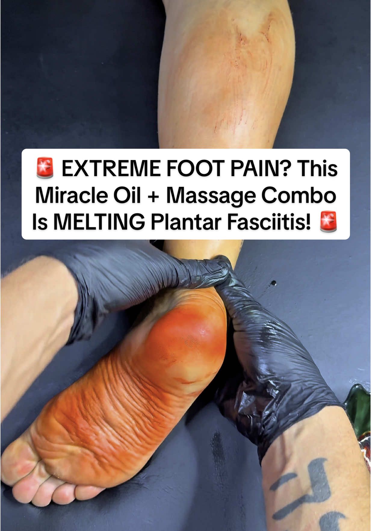 🚨 EXTREME FOOT PAIN? This Miracle Oil + Massage Combo Is MELTING Plantar Fasciitis! 🚨 If you’ve tried everything and still feel like walking on glass—THIS is your game-changer. 😣 Struggling with: 	•	Burning heel pain or stabbing arches? 	•	Tight calves & aching soles? 	•	Foot pain that gets worse with every step? This powerful kinesiology massage + red vitamin-infused healing oil is giving people instant relief—and long-term regeneration. 📖 Description: Most foot pain—especially plantar fasciitis—comes from more than just overuse. It’s fascia damage, nerve stress, inflammation, and scar tissue that keeps coming back. But now there’s a breakthrough combo: A specialized foot massage technique paired with a miracle oil infused with red-colored, vitamin-rich botanicals that: ✅ Break down scar tissue ✅ Regenerate damaged fascia & boost circulation ✅ Relieve nerve tension & inflammation ✅ Bring INSTANT soothing relief from heel and arch pain The red oil is loaded with natural anti-inflammatory and healing ingredients that activate deep tissue repair—right where you need it most. 📅 Book now and take the first step toward walking pain-free again—with the healing boost your feet have been waiting for! 🔥 Viral Hashtags: #FootPainRelief #MiracleFootOil #PlantarFasciitisFix #HeelPainGone #FootMassageMagic #VitaminInfusedHealing #KinesiologyMassage #RegenerativeRelief #RedOilTherapy #MassageBreakthrough #PainFreeFeet #ArchSupportNaturally #FasciaRelease #InflammationRelief #WalkWithoutPain #DeepTissueHealing #NaturalPainRelief #FootRecoveryMagic #HealingStartsAtYourFeet #stepintorelief #footpain #footcare #footpainrelief #plantarfasciitis 