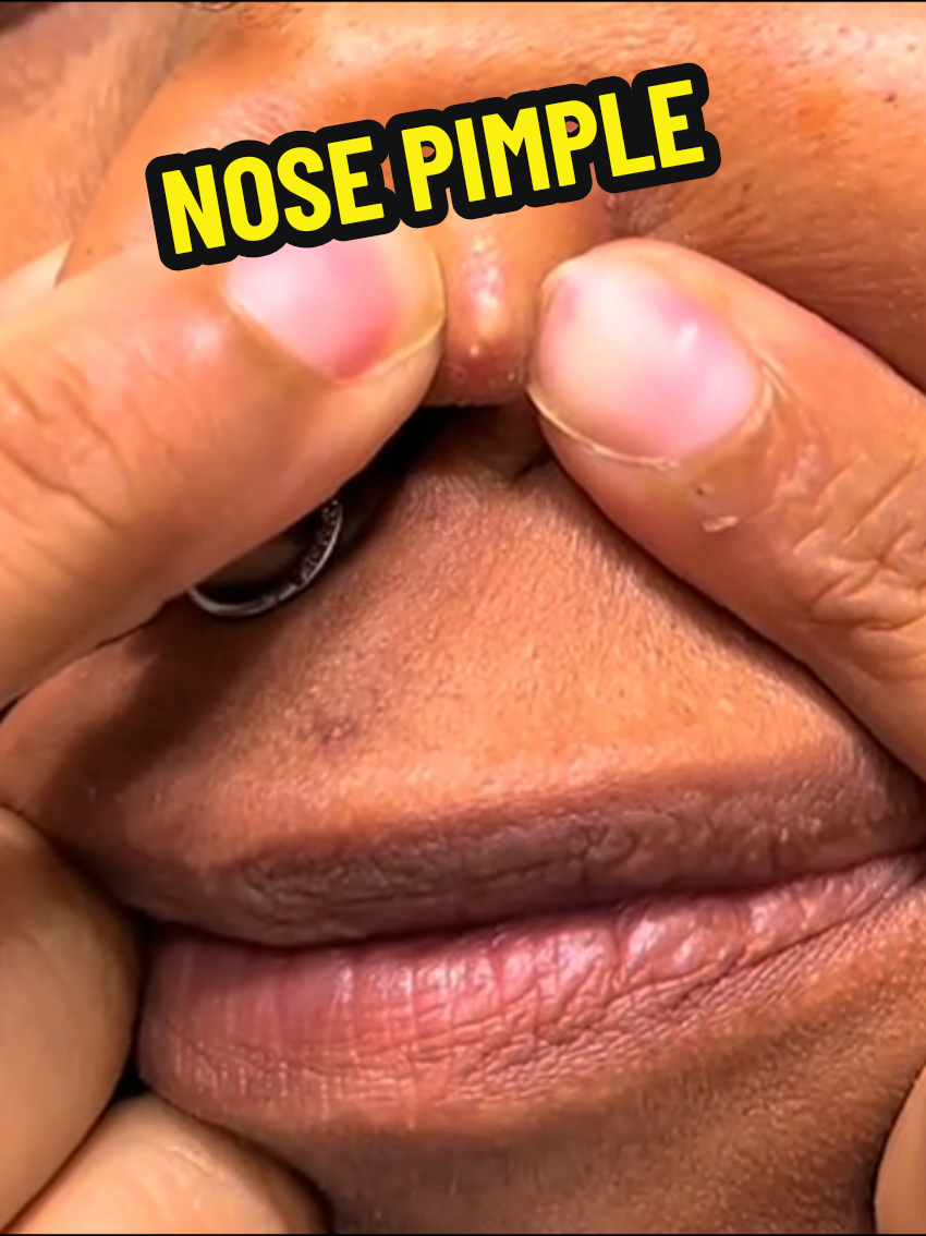 pimple popping#creatorsearchinsights #pimples #pimples #pimplepopper 