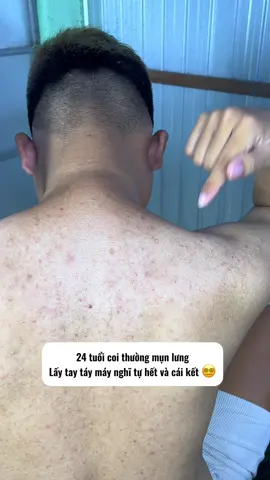 Coi thường mun lưng và cái kết #heyme 