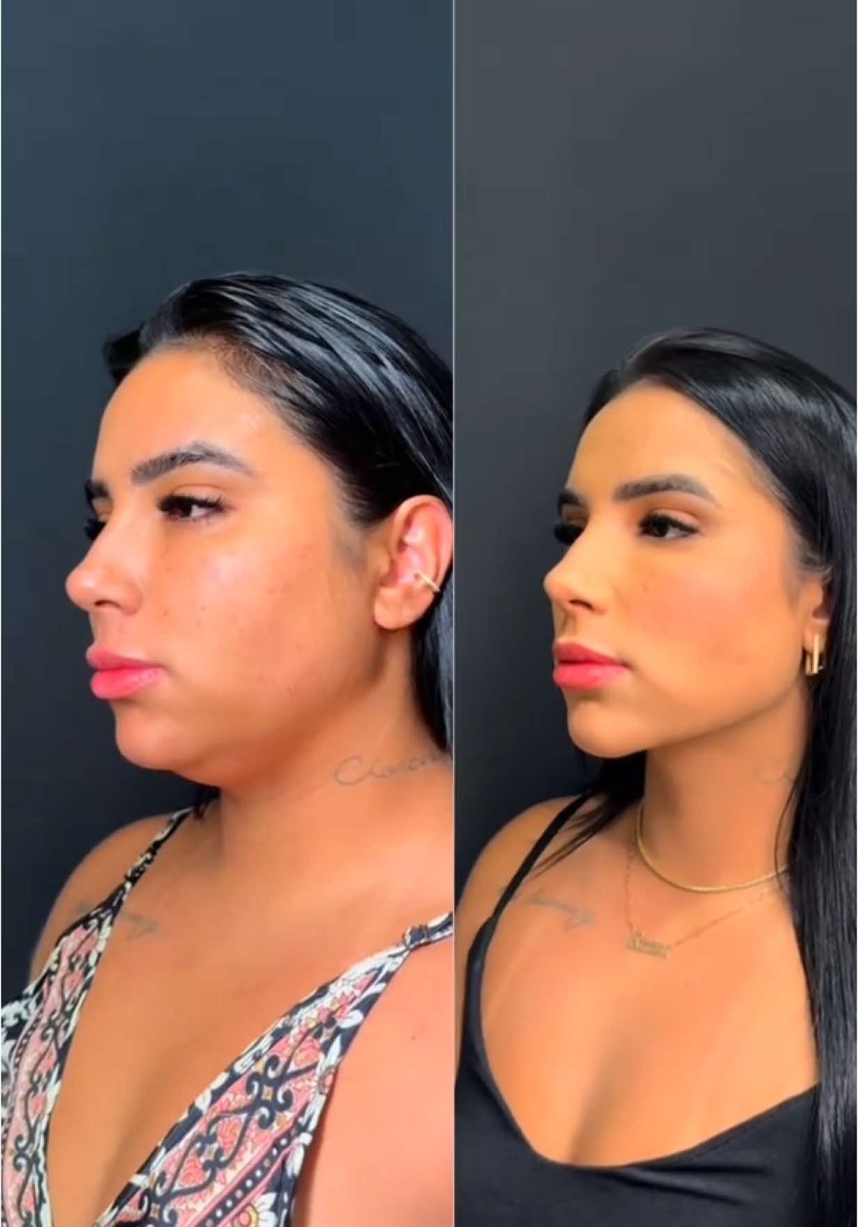 A Lipo de papada foi um divisor de águas na forma como ela se enxerga e se sente. Libertador é pouco! Ela está radiante, segura, e mais ela do que nunca. A beleza de um procedimento está em resgatar aquilo que sempre esteve ali: a nossa essência. #lipodepapada #papada #platismoplastia #liftingmento #harmonizacao #trend #foryou 