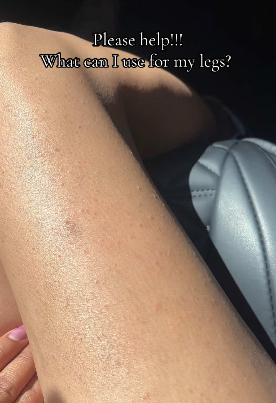 Help a girl out please😩 never had this problem,after I had my babygirl this has been happening and I don’t know what to use. #skintips#bumpyskin#bumpylegs#clearskin#glowingskin#legs#acne#skincondition#fyp#viral#tiktokdoyourthing#paratii