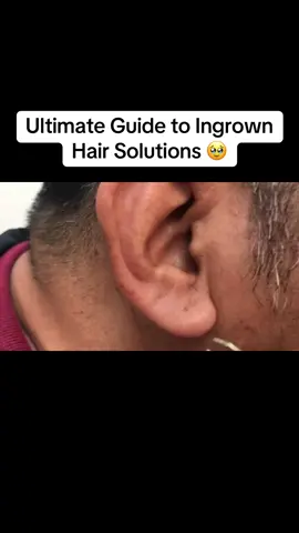 Ultimate Guide to Ingrown Hair Solutions #ingrownhair, #skincare, #shavingtips, #SelfCare, #skincareroutine  