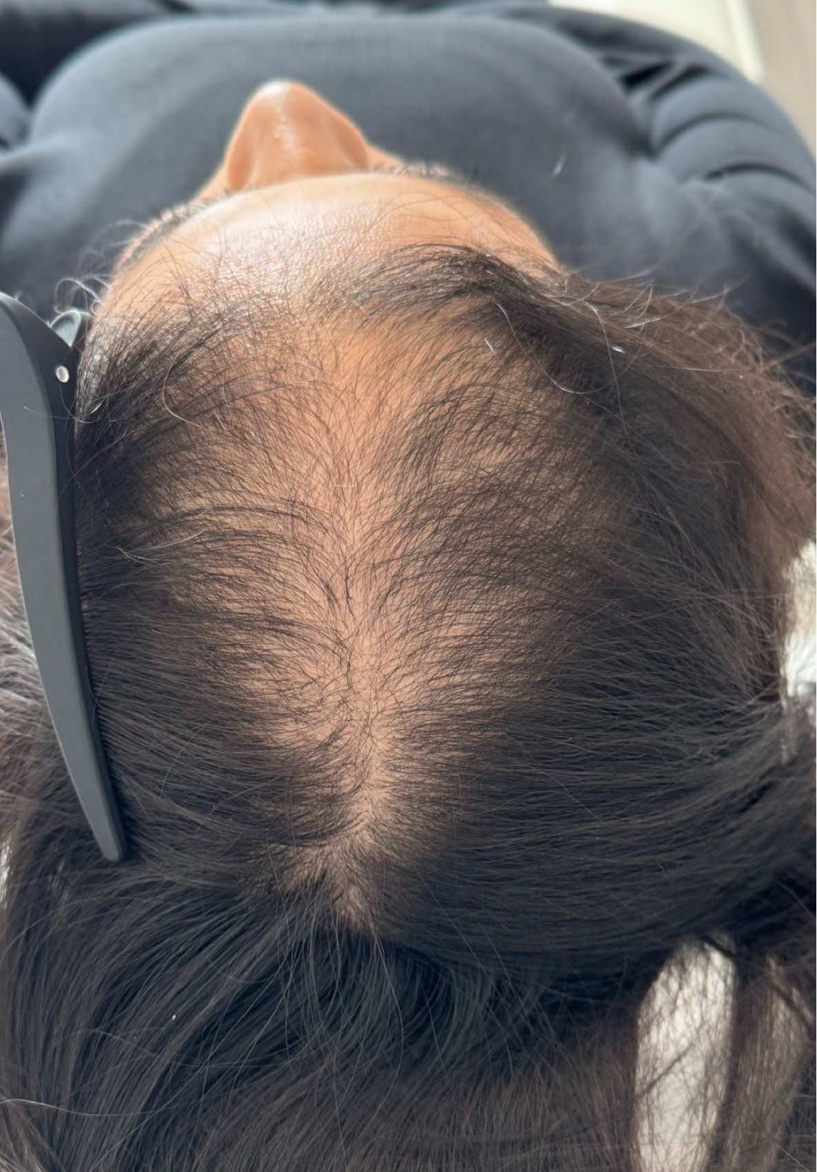 Before and after PRP & Mesotherapy Hair Restoration. Healthier, thicker hair growth ✅  #prplondon #hairrestoration #prp #hairlosssolutions 