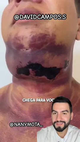 Lipo de papada #lipodepapada #mandibula #drdavidcampos 