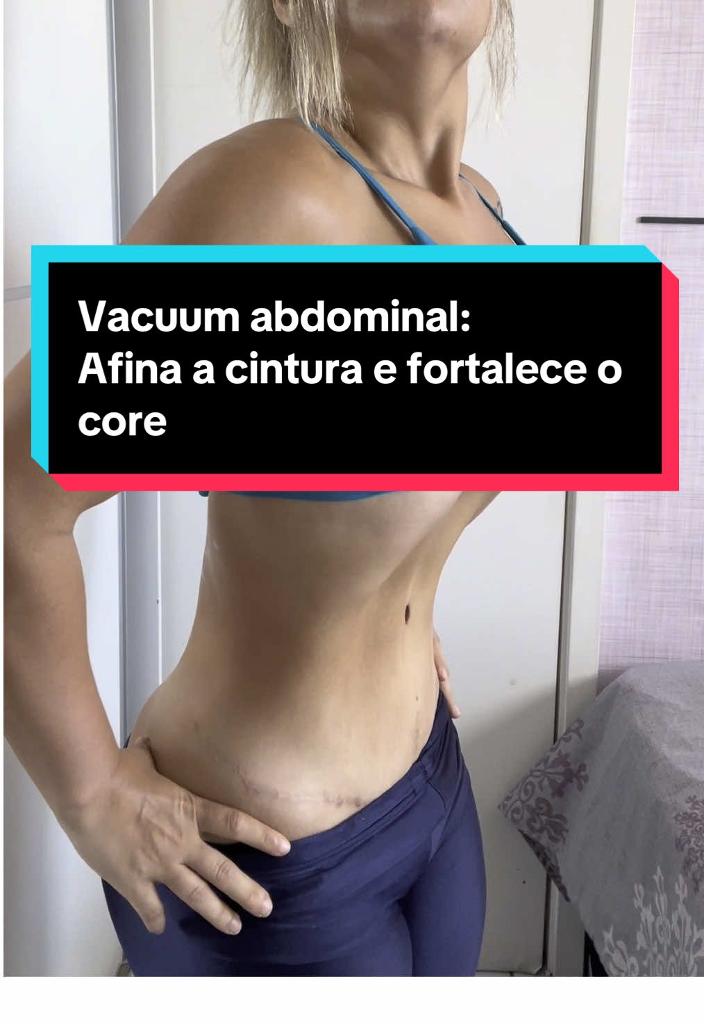 Fez lipo ou abdominoplastia? Então SALVA esse post e aprende a fazer o VACUUM! ⠀ Técnica simples que: Afina a cintura Ativa o abdômen profundo Melhora postura Evita flacidez e barriga estufada ⠀ Como fazer: Estômago vazio Inspira fundo Solta TODO o ar Puxa o abdômen pra dentro e segura 10-15s Repete 3x ⠀ Pós-cirurgia: Lipo HD: pode fazer com liberação Abdominoplastia: só após 30-45 dias com ok do médico ⠀ Contraindicações: gestantes, hérnia abdominal ou problemas respiratórios ⠀ Me segue pra mais dicas e salva esse post pra testar depois! #vacuum #vacum #vacuumabdominal #afinarcintura #perderbarriga #fortalecimentodecore #core #fortalecimentoabdominal #abdominoplastia #lipo #lipohd #foryoupage #foryou #foryoupage❤️❤️ #so #vaiprofy 