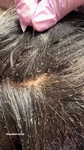 Can you see them crawling #fypシ  #FYP  #foryoupage #piojos #corpuschristitexas #headlice #TREATMENT #momssupportingmoms #TEXAS #bugs #liceremoval 