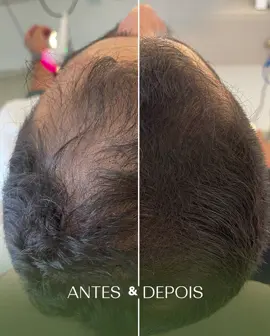 Calvície MASCULINA A diferença entre essas fotos é de menos de 2 meses e o resultado super visível. O paciente continua em tratamento (terapia capilar + injétaveis). A excelência dos profissionais, o uso correto dos produtos e a disciplina do paciente fazem completa diferença para obter resultado. Entre em contato para mais detalhes!✨ #calvicie #calviciemasculina #calviciefeminina #careca #terapiacapilar #microagulhamento #fyy #foryoupage 